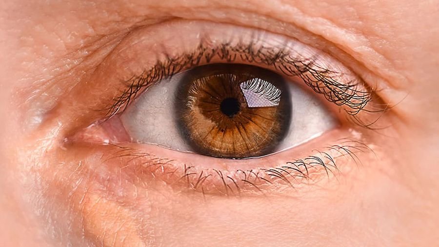 Yellow Eye Spots May Signal Heart and Stroke Risks